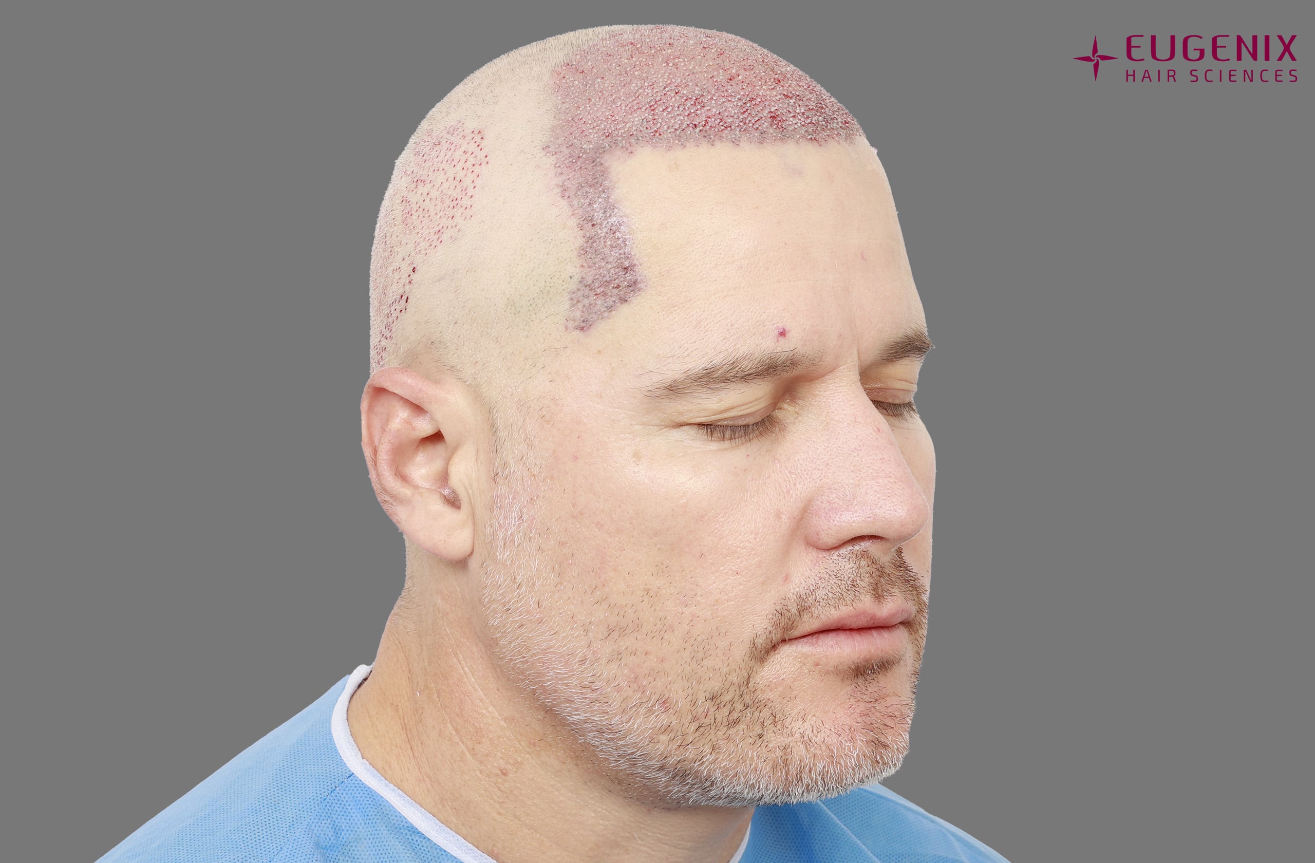 Morne Van Wyk Post-op Left