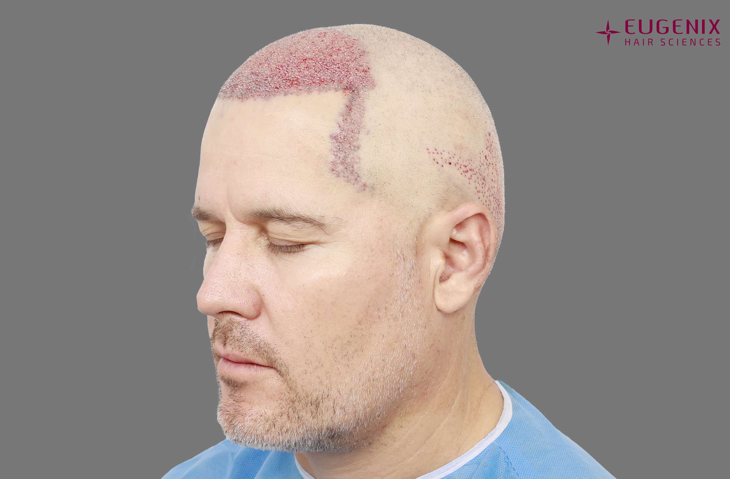 Morne Van Wyk Post-op Right