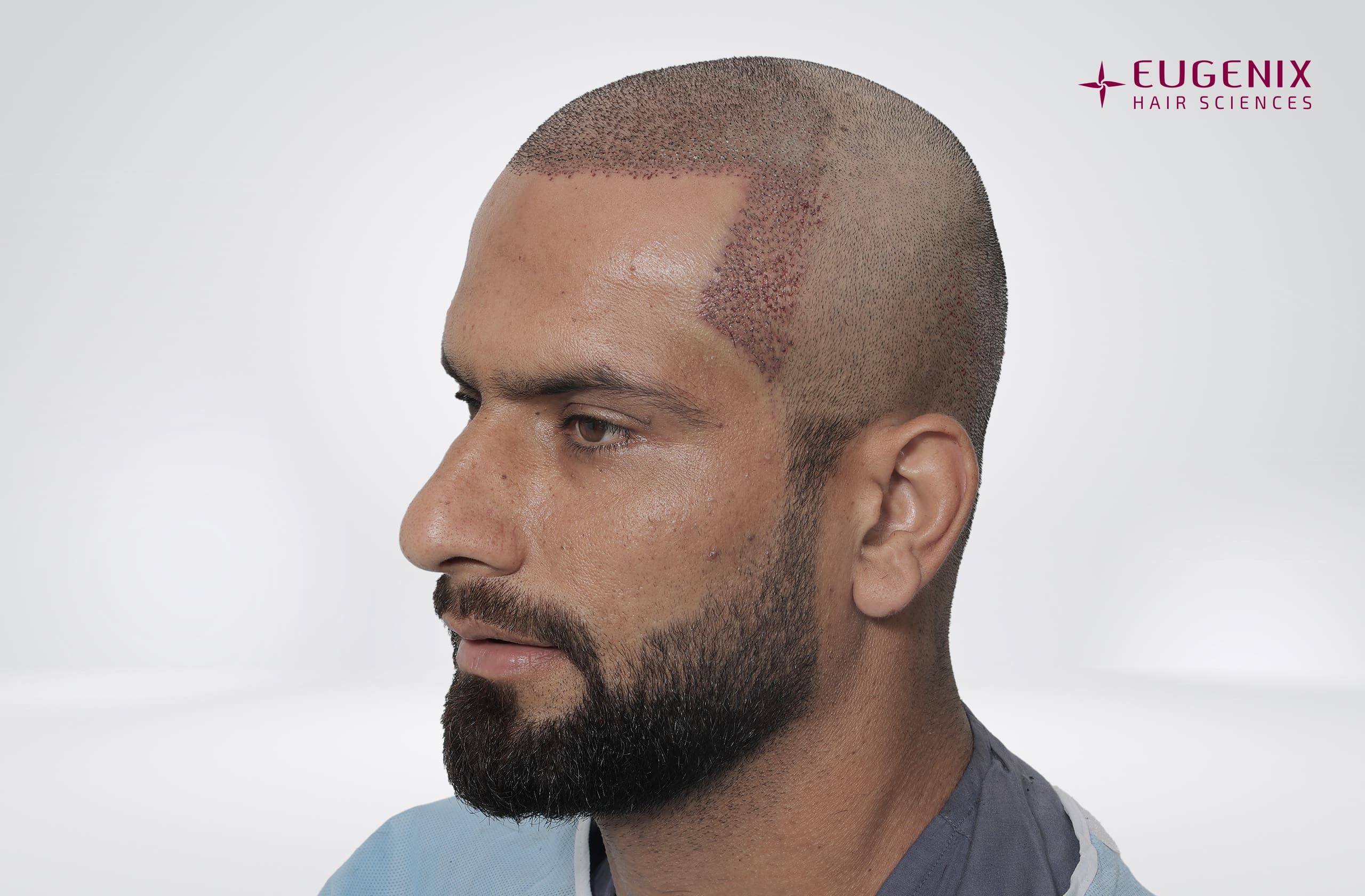 Fareed Ahmad Post-op Left