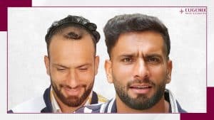 Farid-Malik-Hair-Transplant