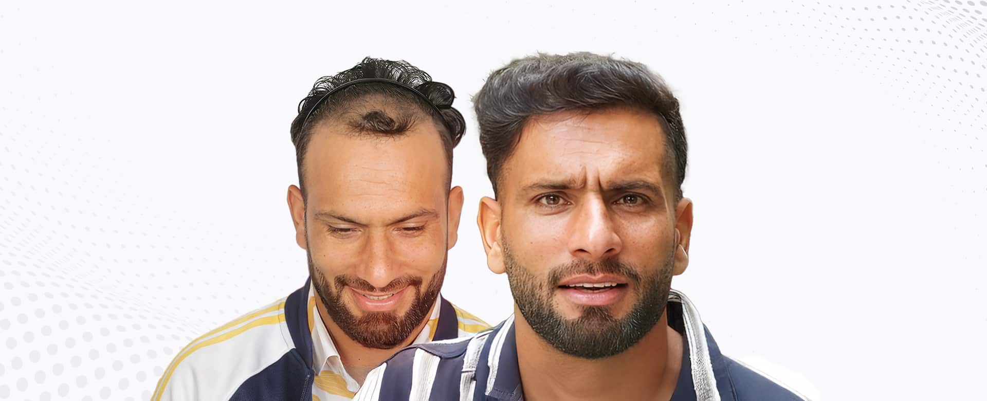 Fareed Ahmad Malik: A Story of Resilience, Cricket and Confidence after Hair Transplant