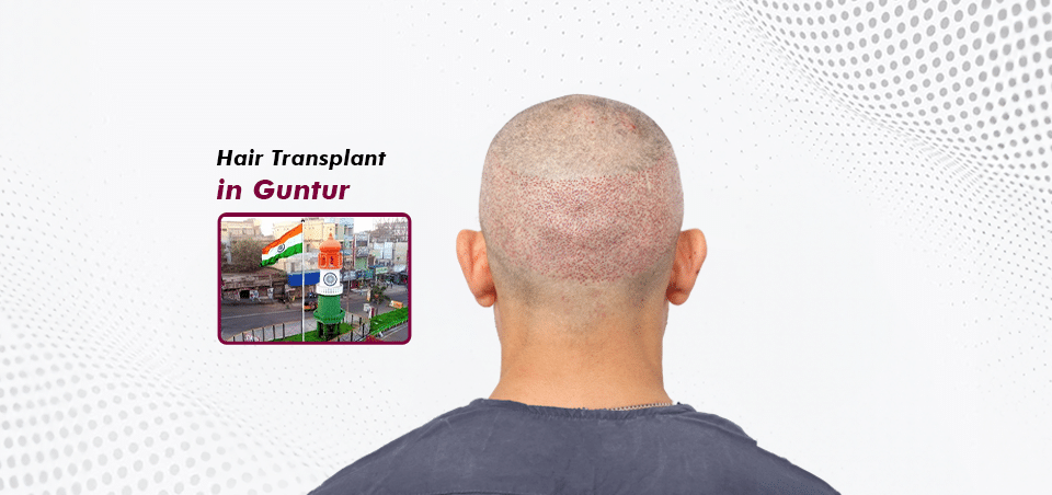 Hair Transplant-in Guntur