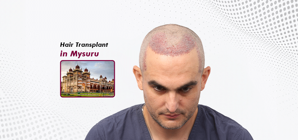 Hair Transplant-in Mysuru