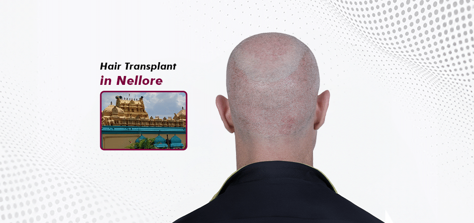 Hair Transplant-in Nellore