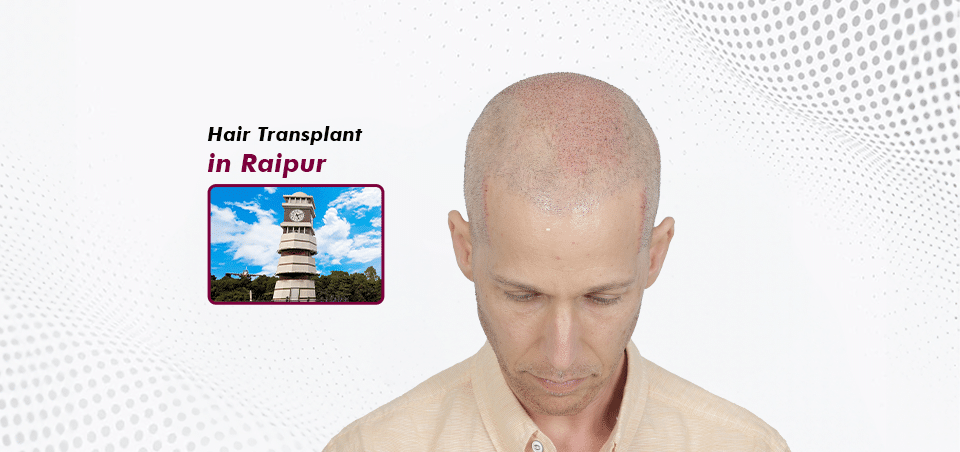 Hair Transplant-in Raipur