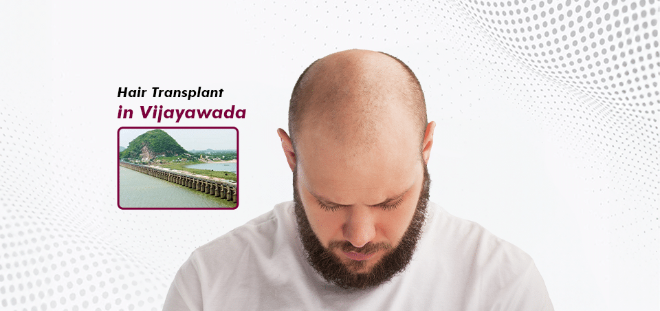 Hair Transplant-in Vijayawada
