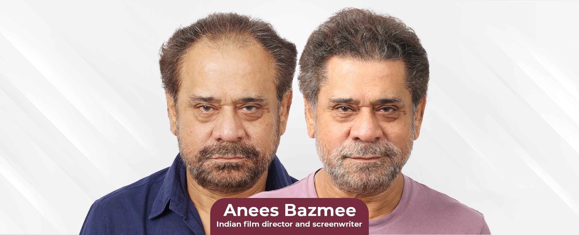 Anees Bazmee Gets a Hair Transplant: The Film Director’s Fresh Start After Bhul Bhulaiyaa 3!