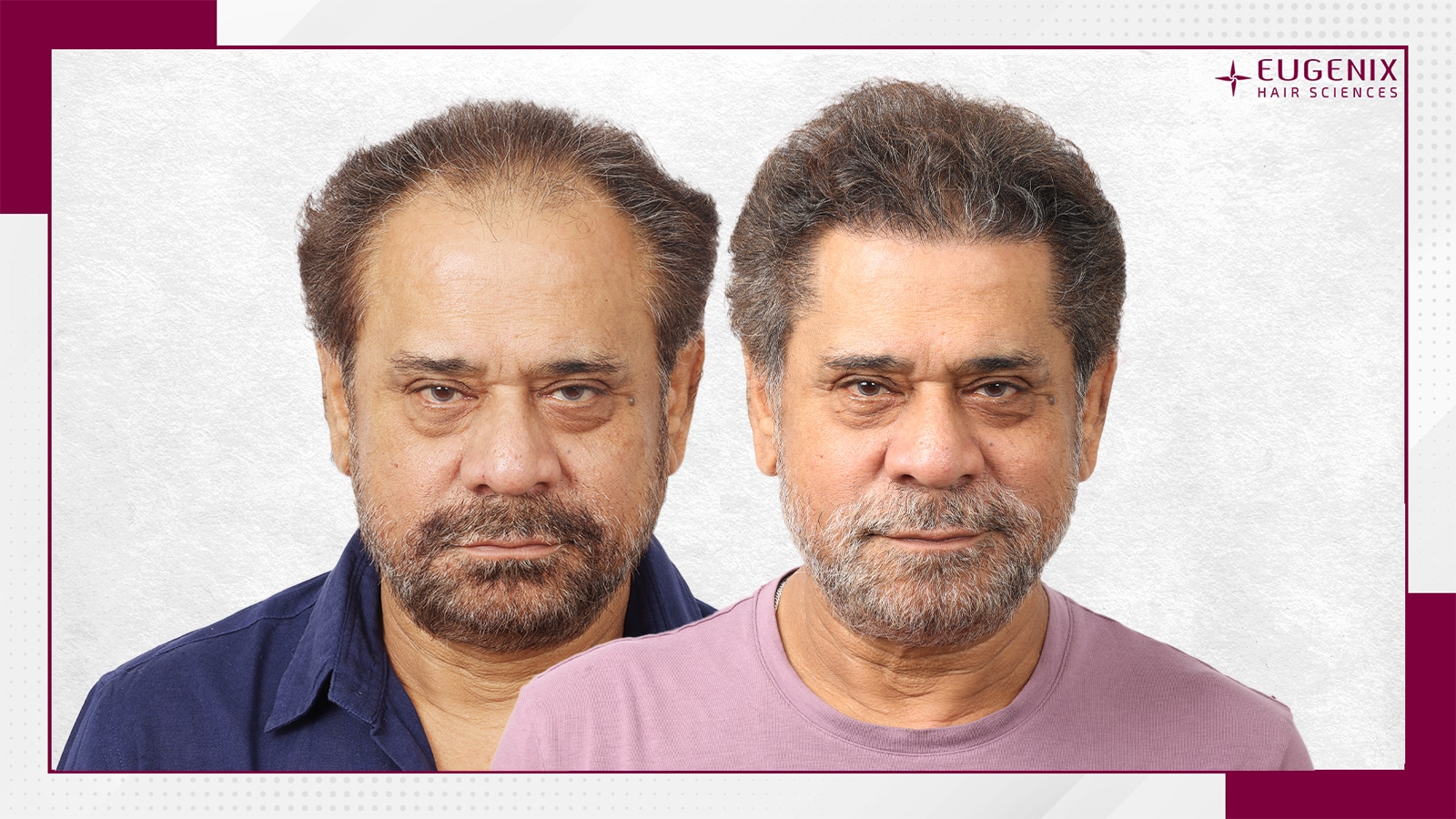 Anees Bazmee Front Before and After copy