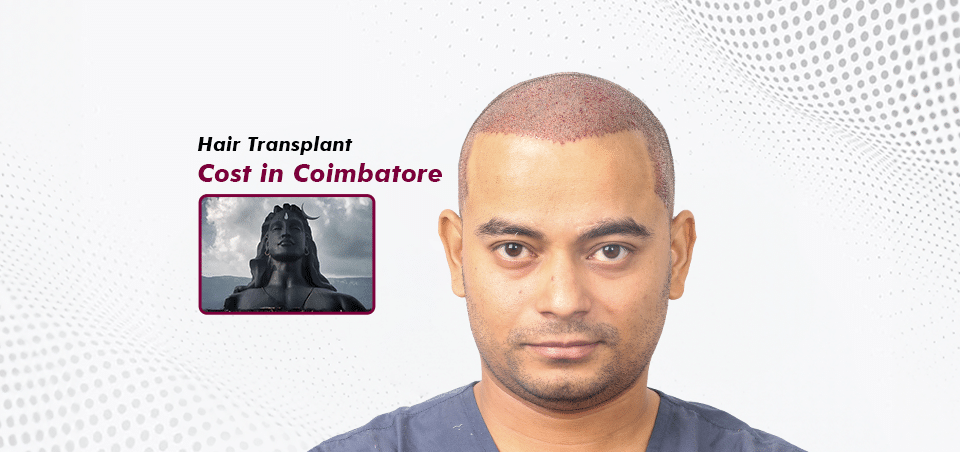 Hair-Transplant-Cost-in-Coimbatore