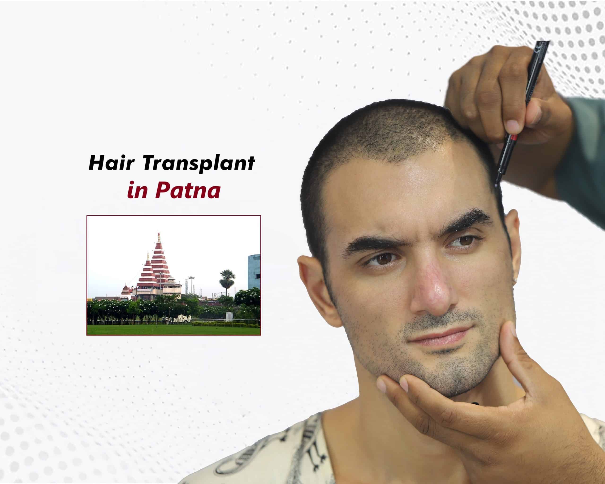 Hair Transplant in Patna