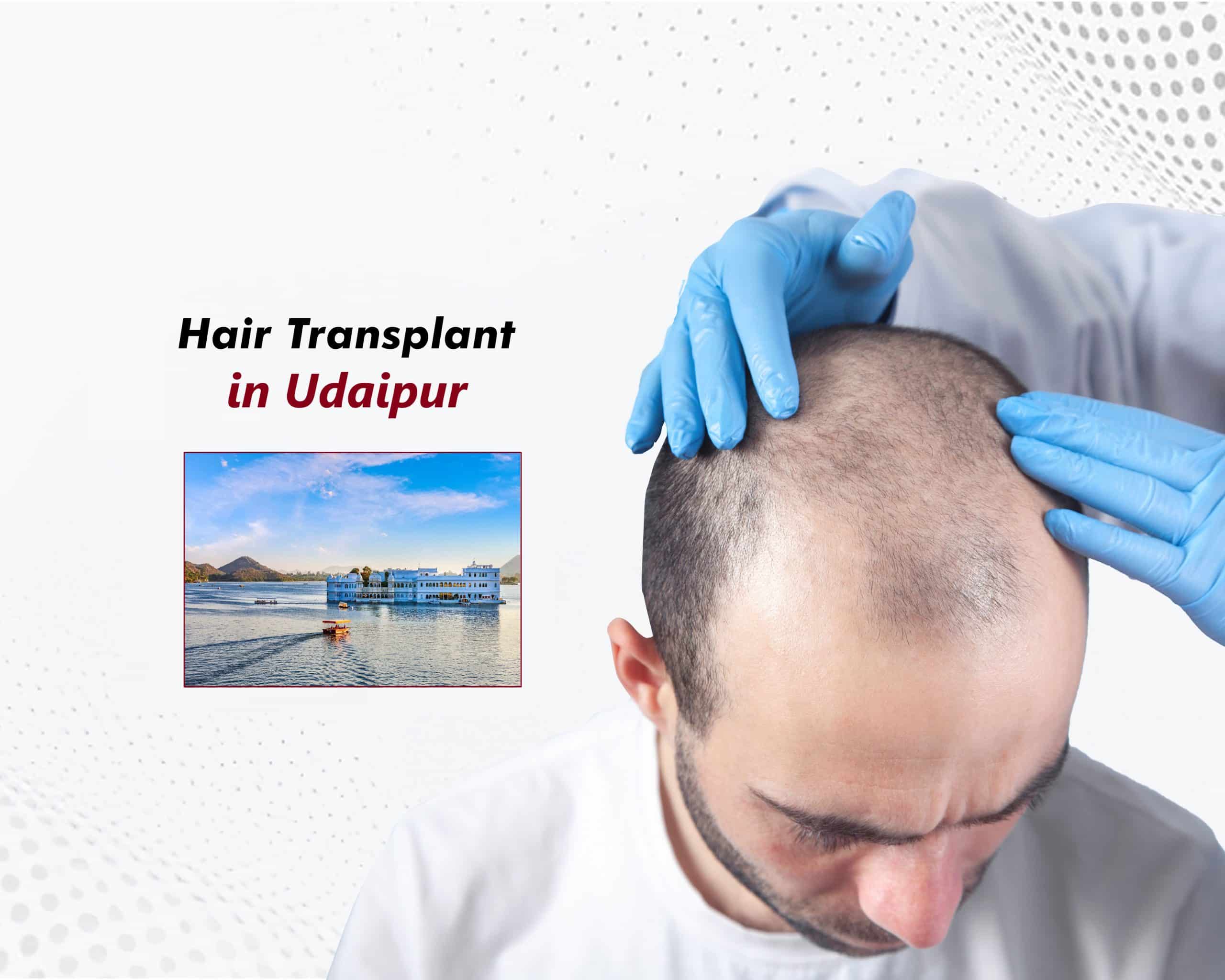 Hair Transplant in Udaipur