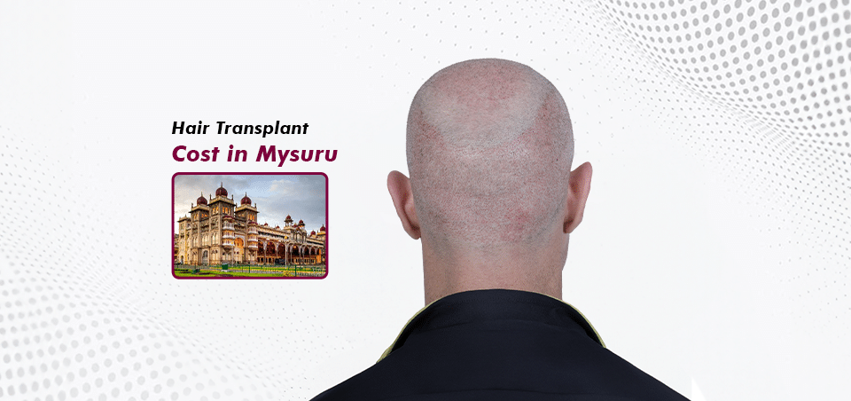 Hair Transplant_in Mysuru