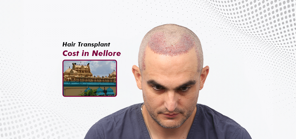 Hair Transplant_in Nellore