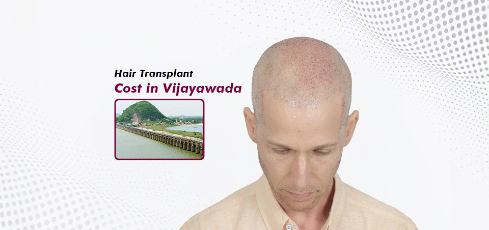 Hair Transplant_in Vijayawada