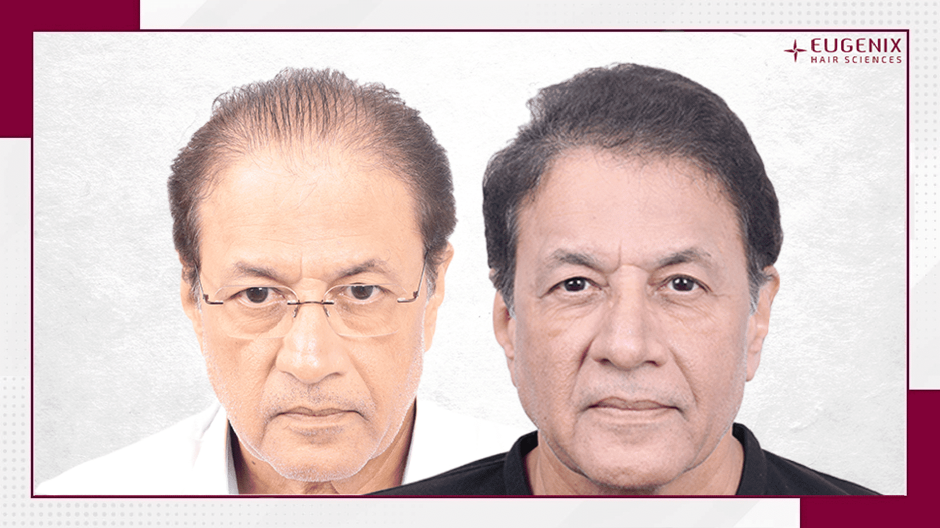 arun-govil-hair-transplant-results-new