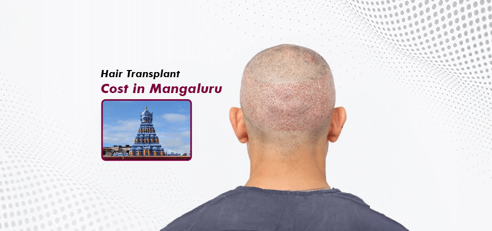 hair-transplant-cost in-mangaluru
