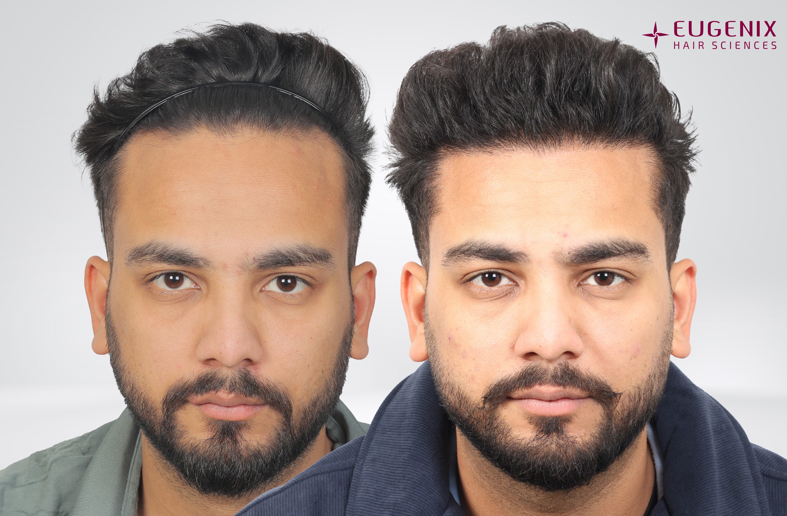 Elvish Yadav Front Before and After
