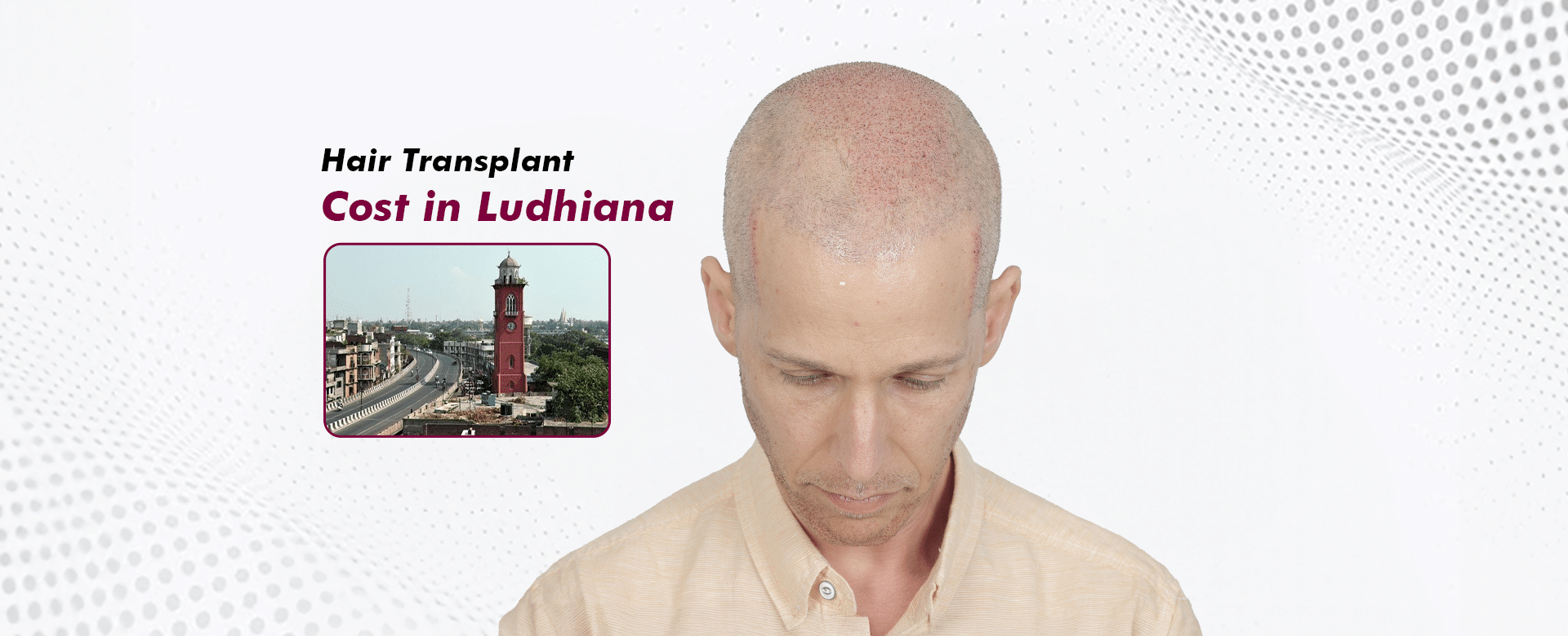 Hair-Transplant-Cost-in-Ludhiana