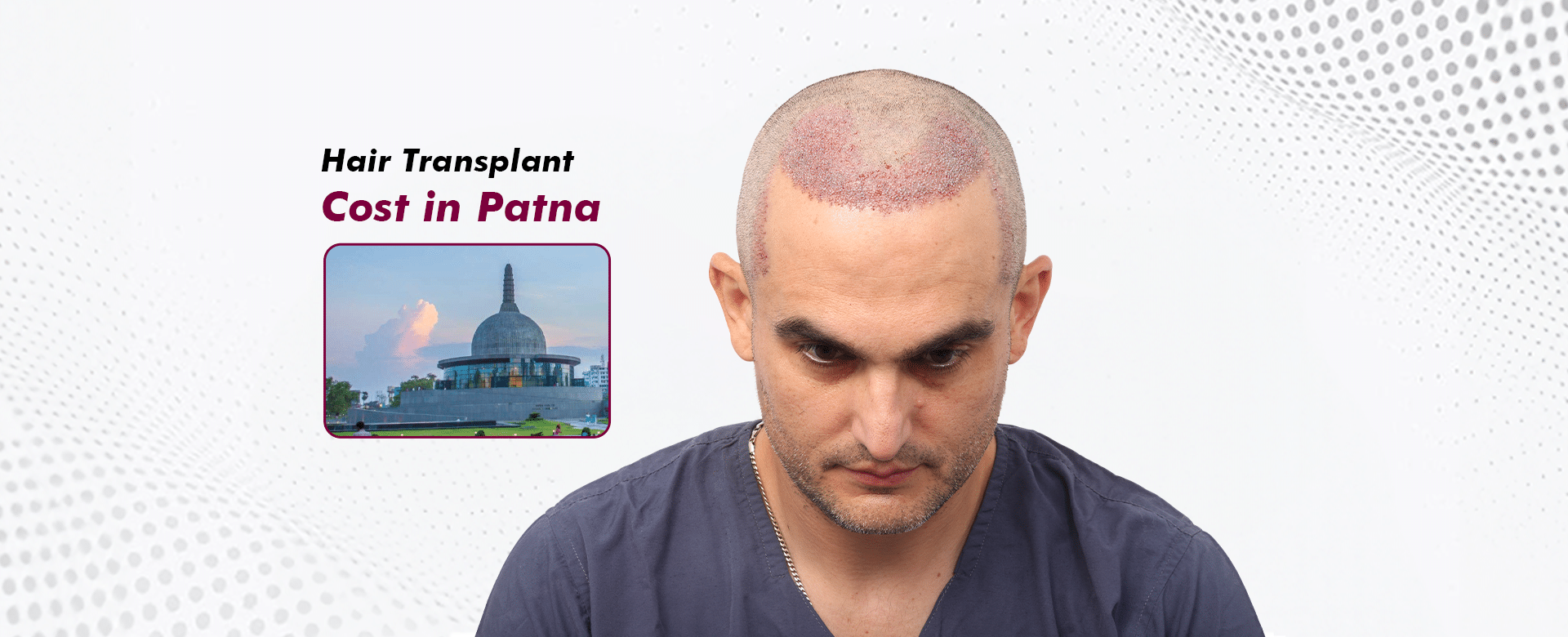 Hair Transplant_Cost in Patna