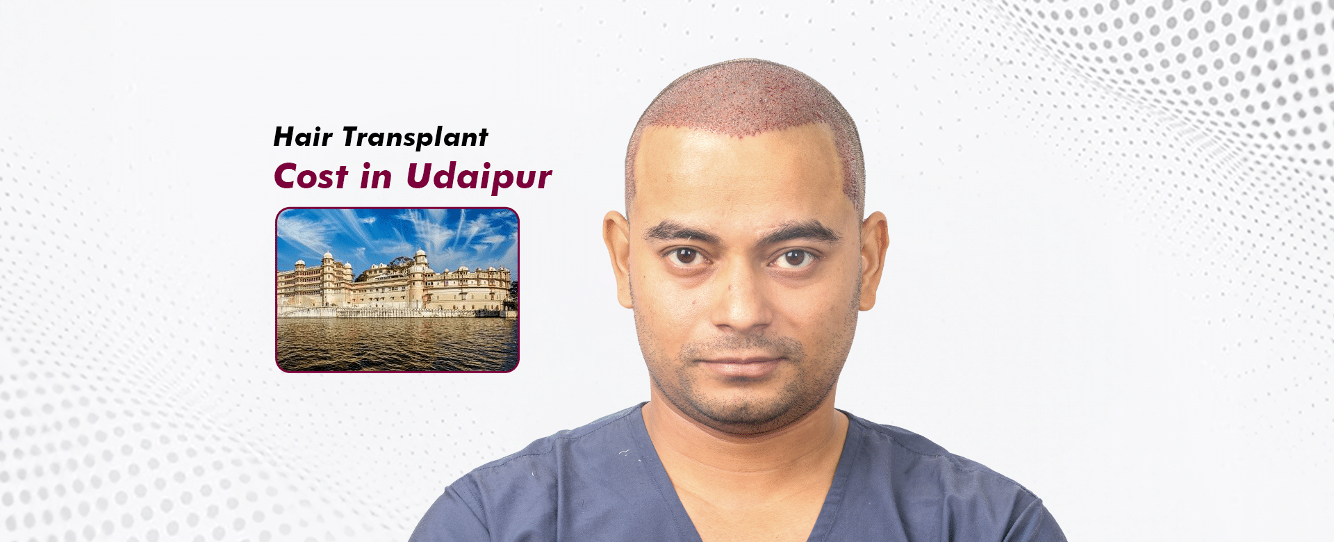 Hair Transplant_Cost in Udaipur