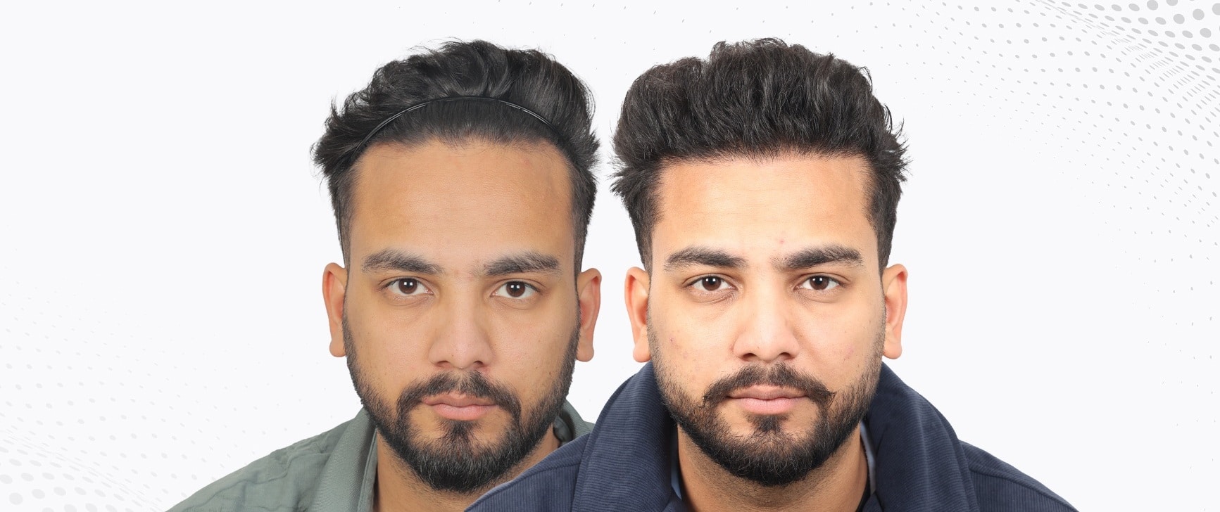 Why Hair Transplantation is a Game Changer: Key Benefits