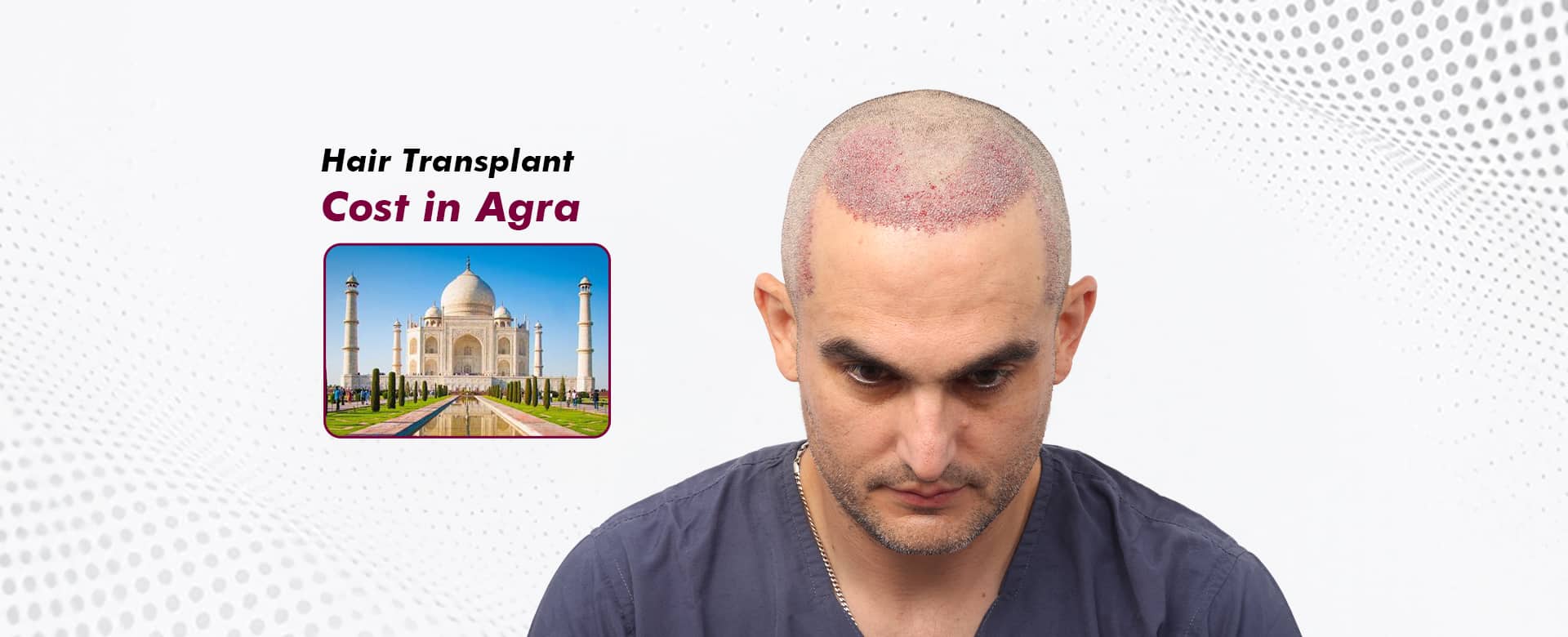 Hair-Transplant-Cost-in-Agra