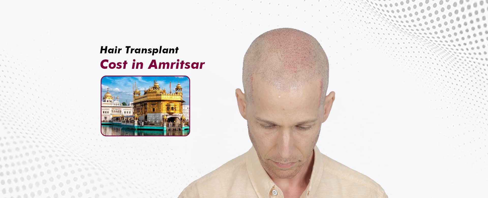 Hair-Transplant-Cost-in-Amritsar