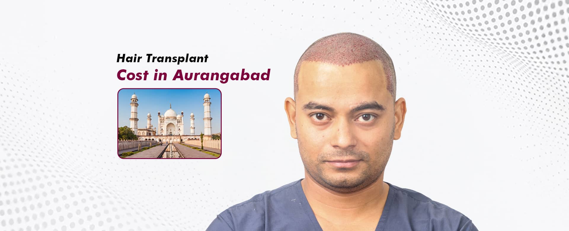 Hair-Transplant-Cost-in-Aurangabad