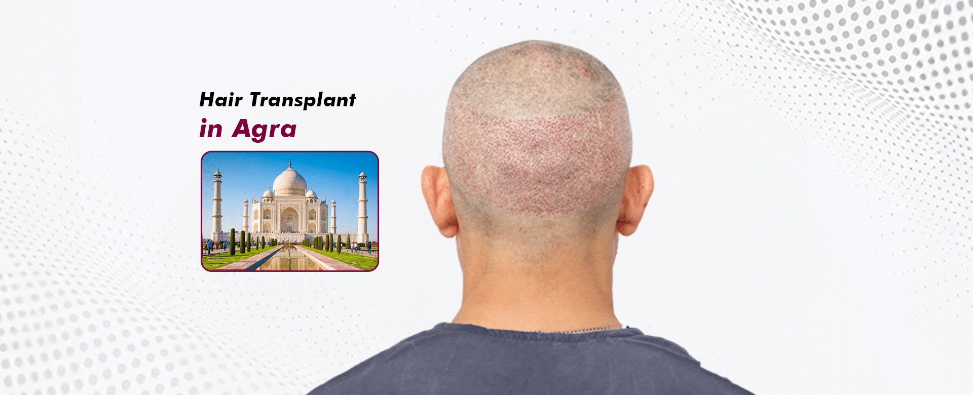 Hair-Transplant-in-Agra