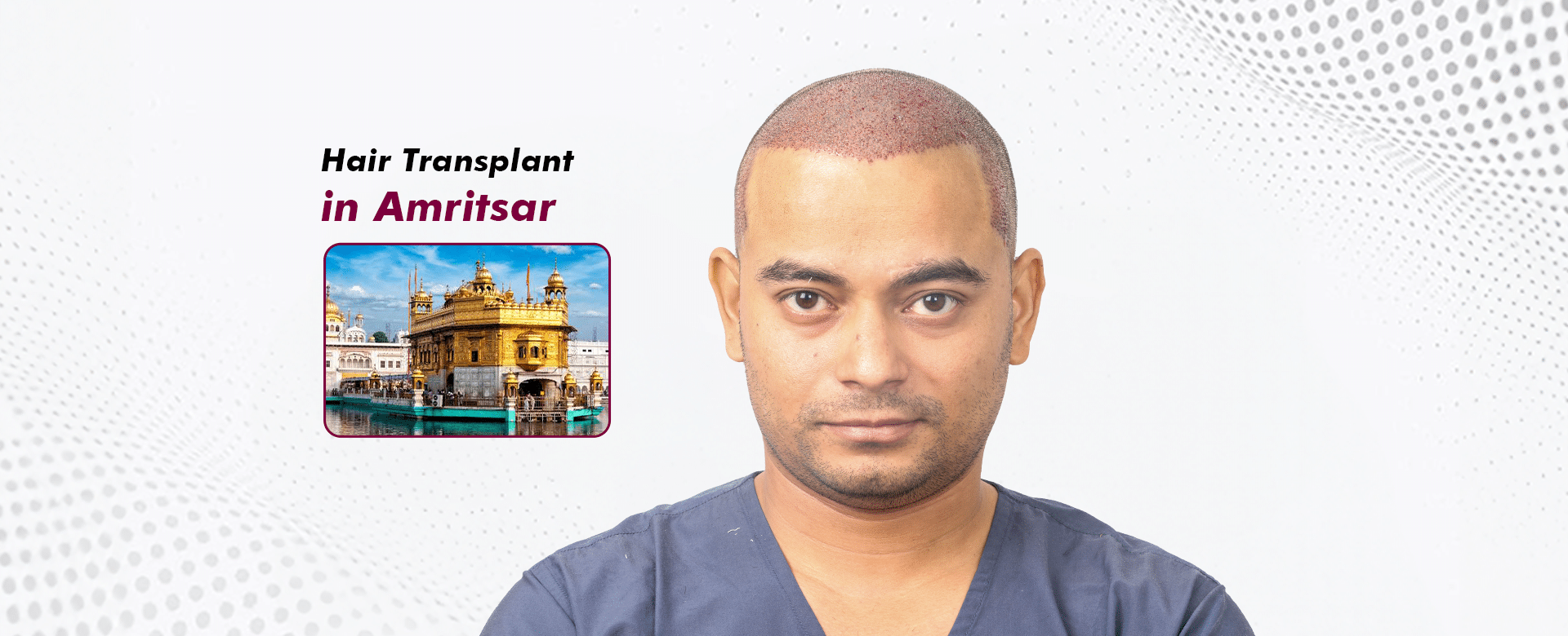 Hair-Transplant-in-Amritsar