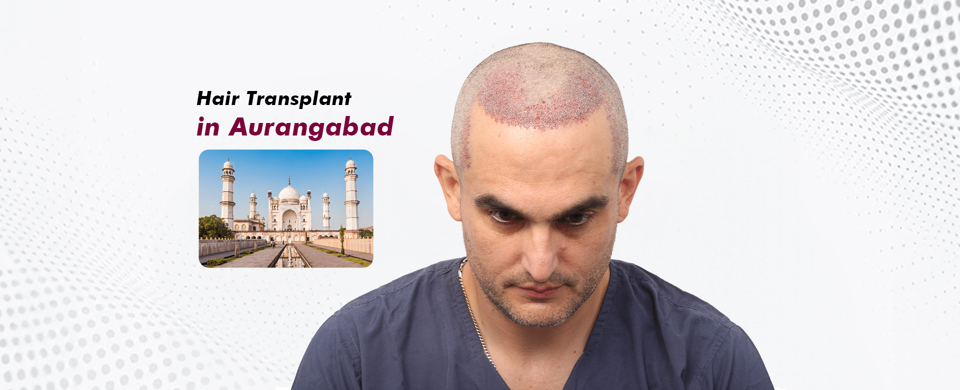 Hair-Transplant-in-Aurangabad