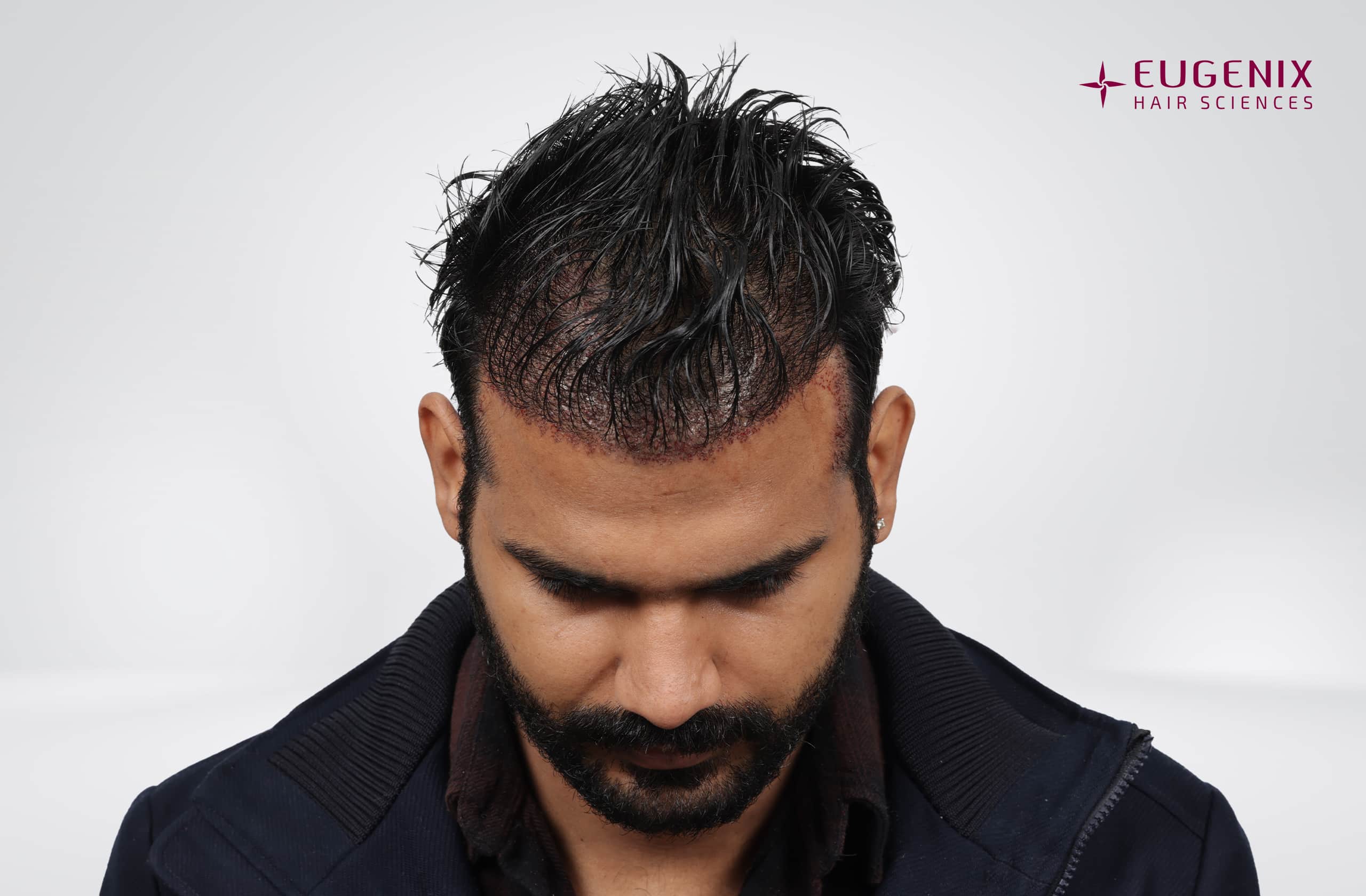 Paramvir Singh Benival Post-op Head Down copy