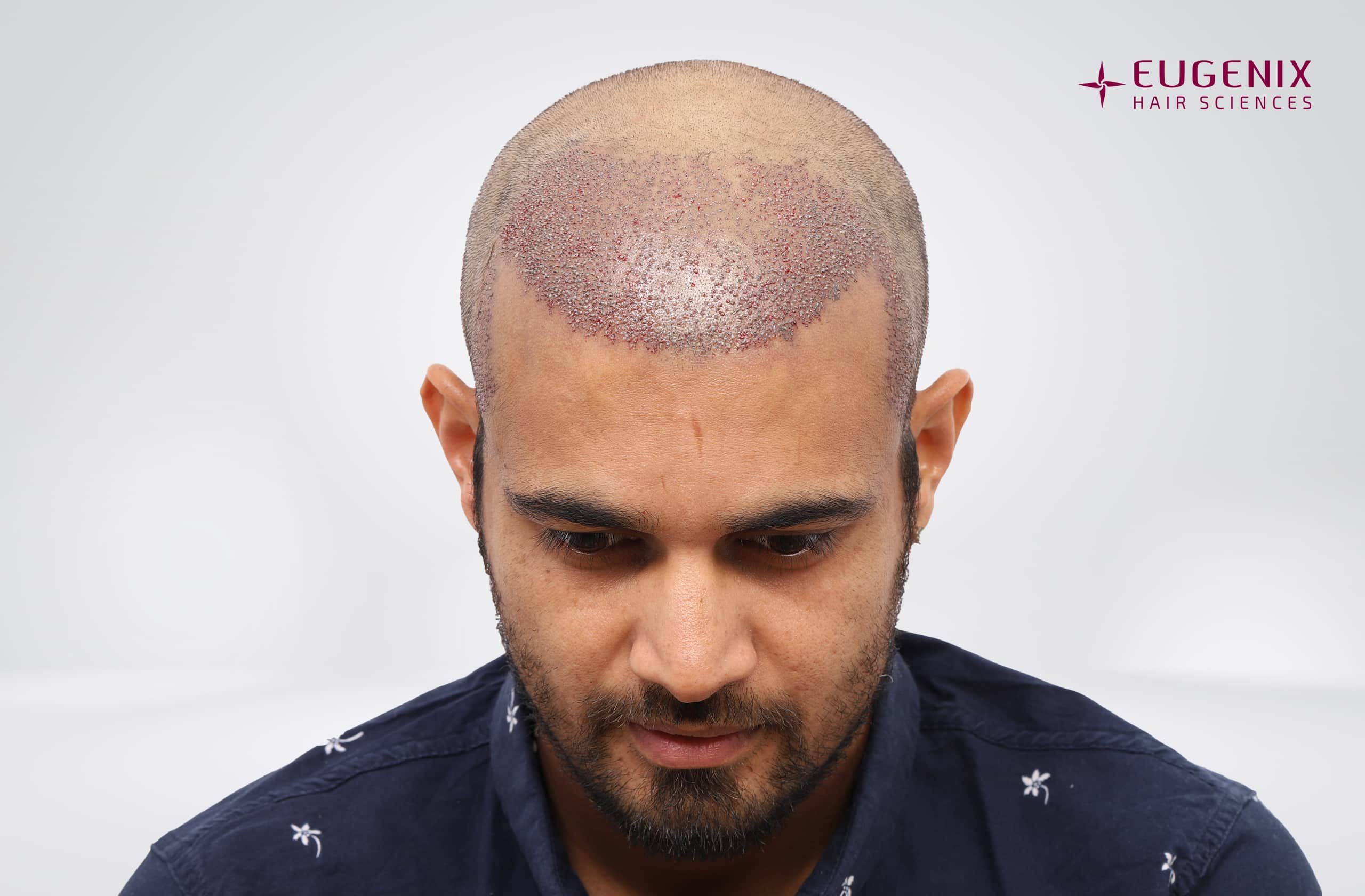 Siddharth Kaul Post-op Head Down copy