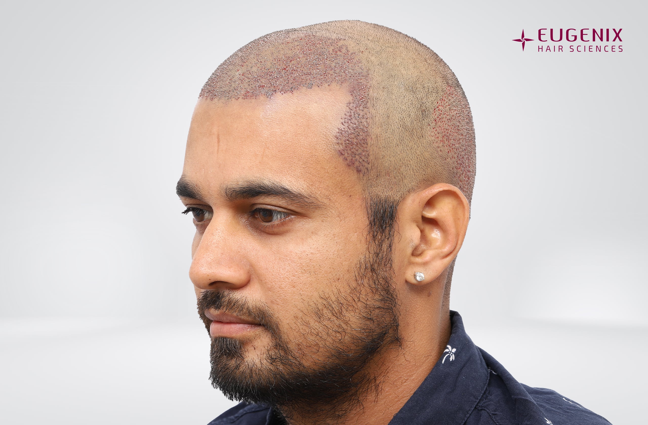 Siddharth Kaul Post-op Right copy