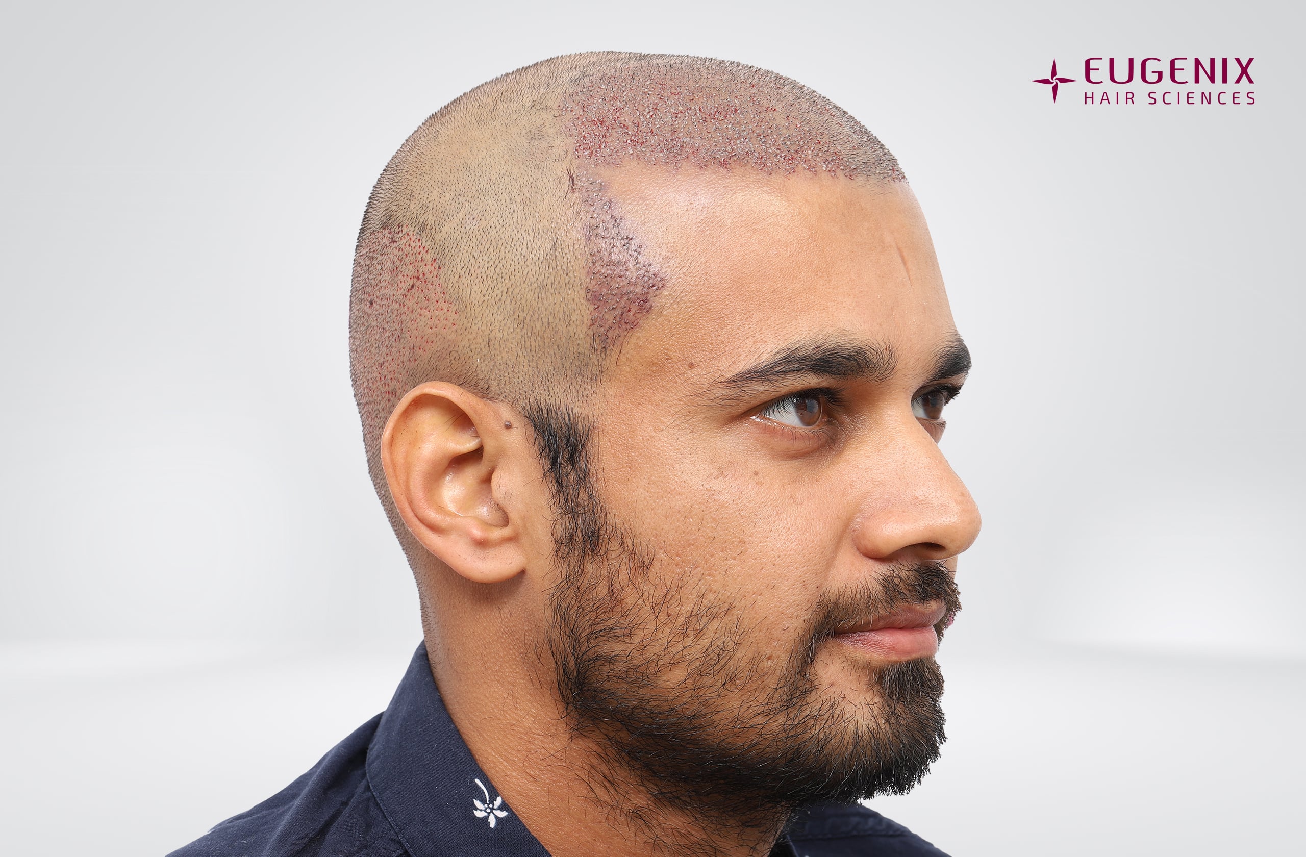 Siddharth Kaul Post-op left copy