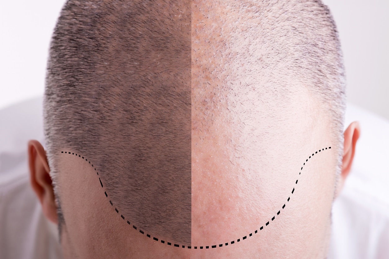 Hair Loss - Before and After