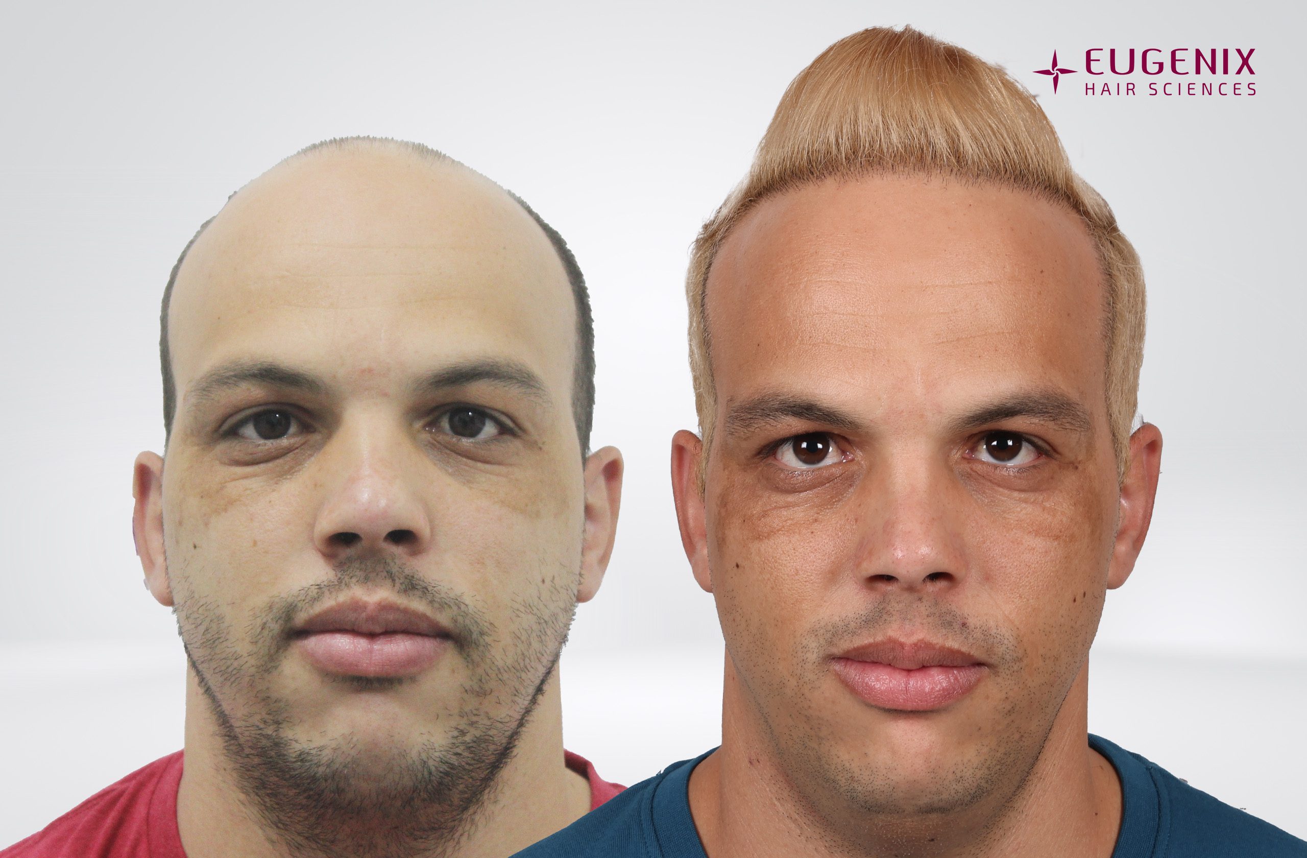 Anton-Front-Before-and-AFter