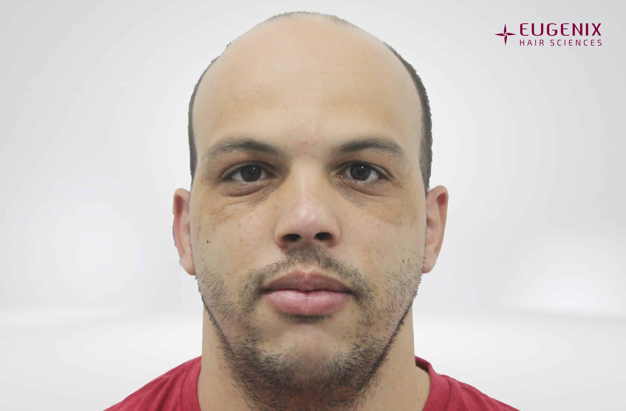 Anton-Front-Before