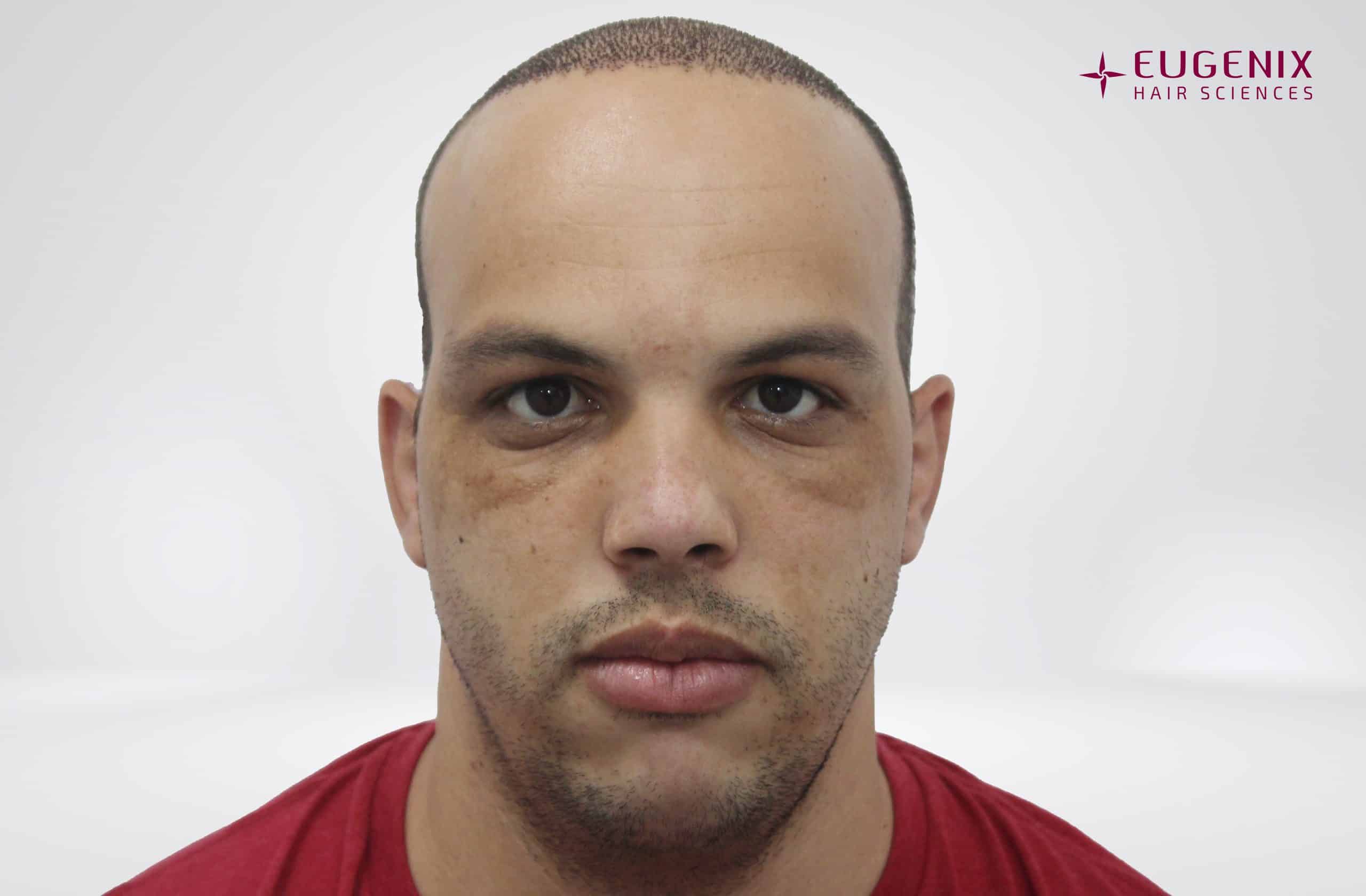 Anton-Front-Post-Op