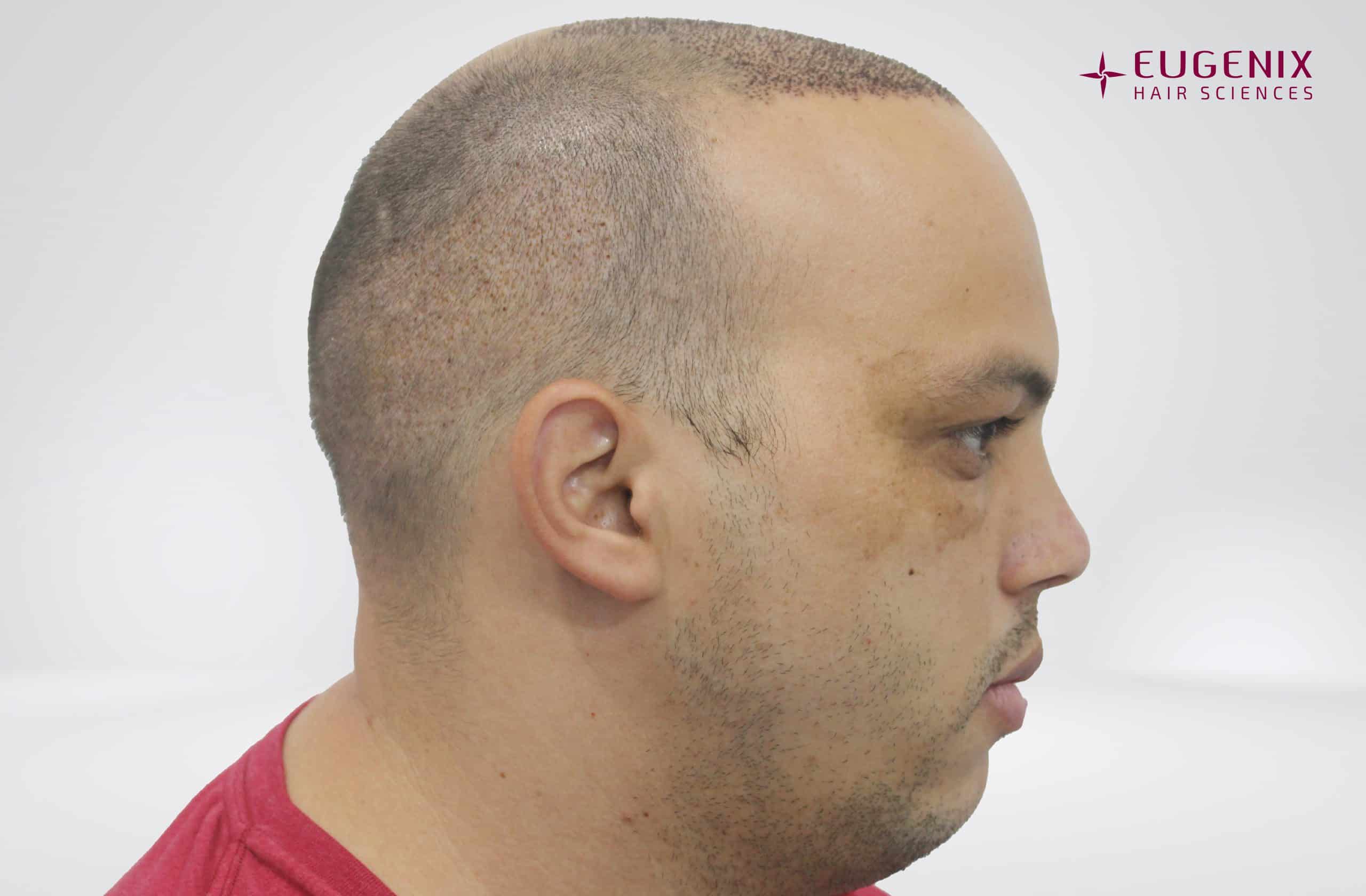 Anton-Left-Post-Op