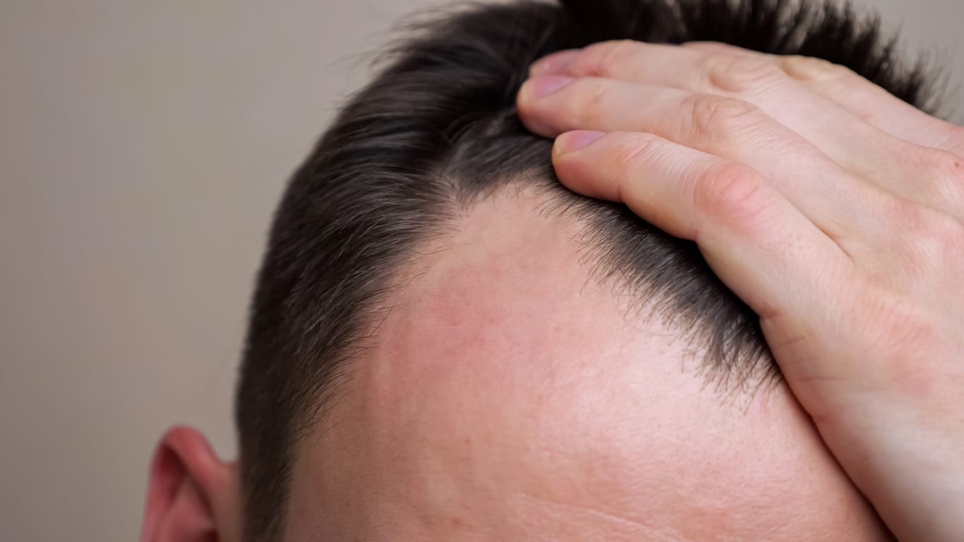 Young man examines his bald spots in the mirror