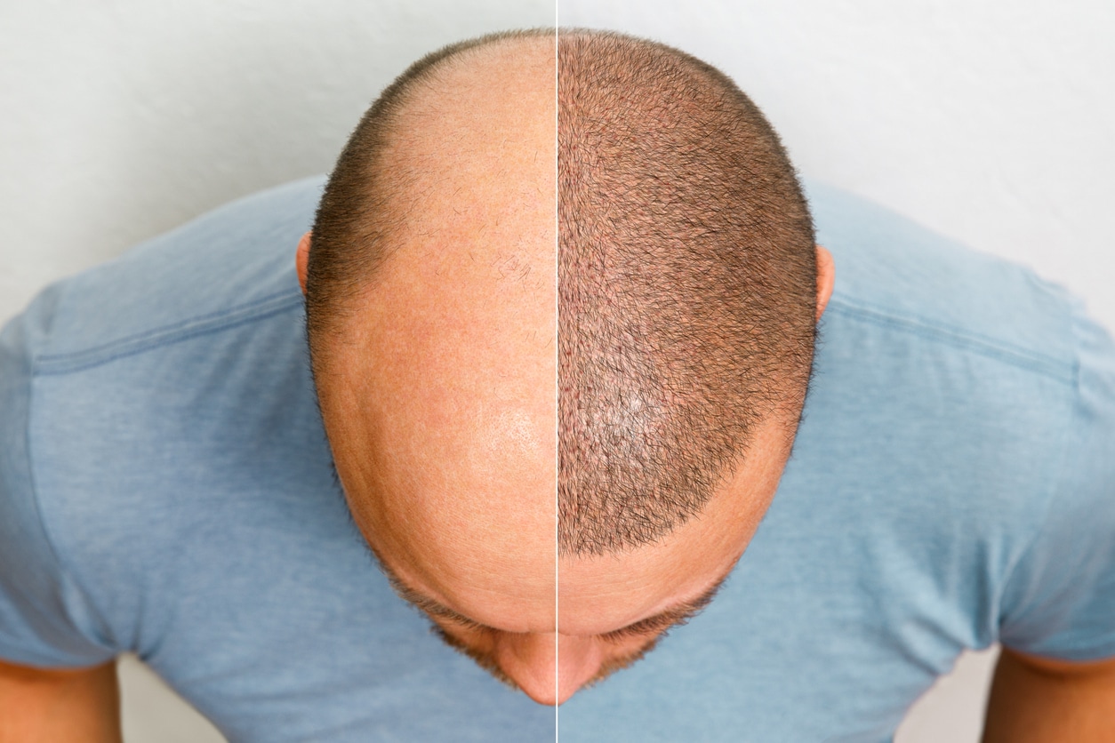 Hair Transplant Pricing: The Importance of Investing in Quality and Trust
