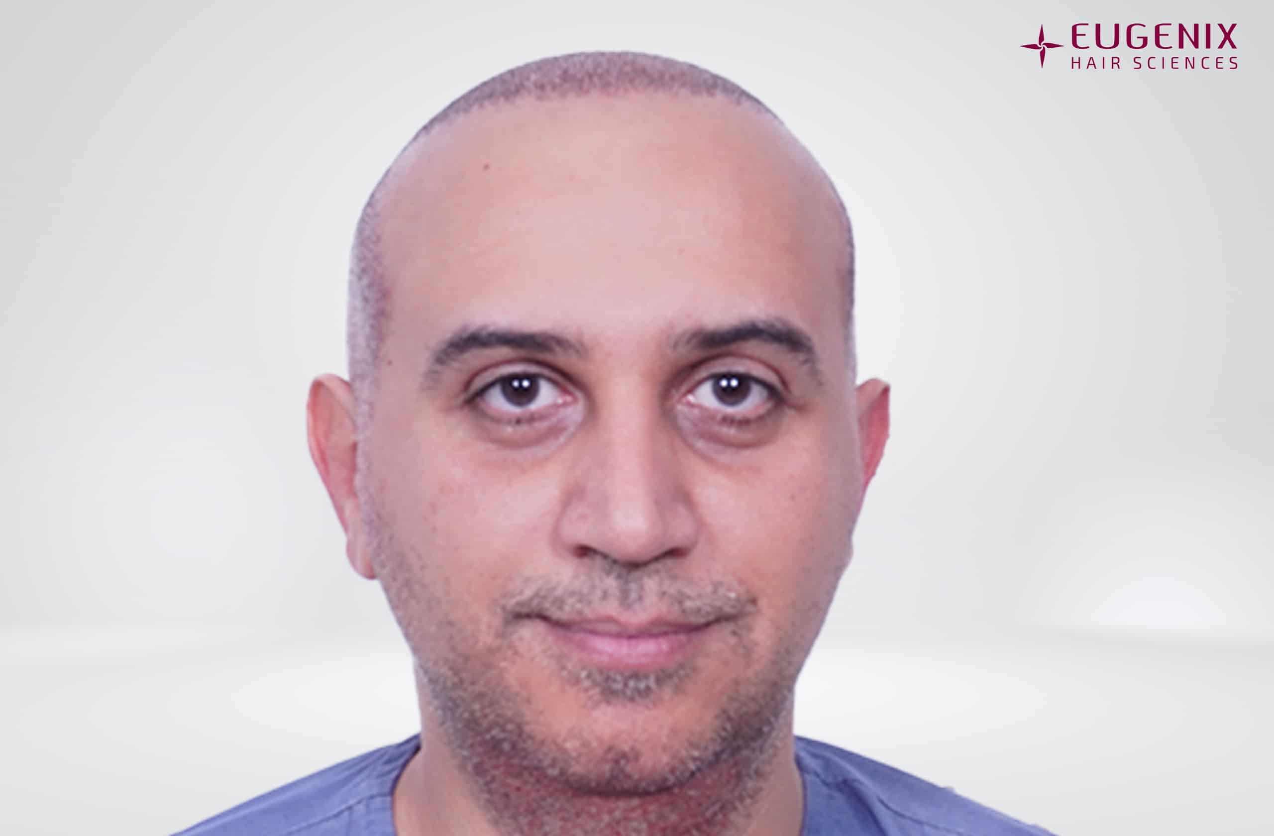 Mr-AS-Front-Post-op