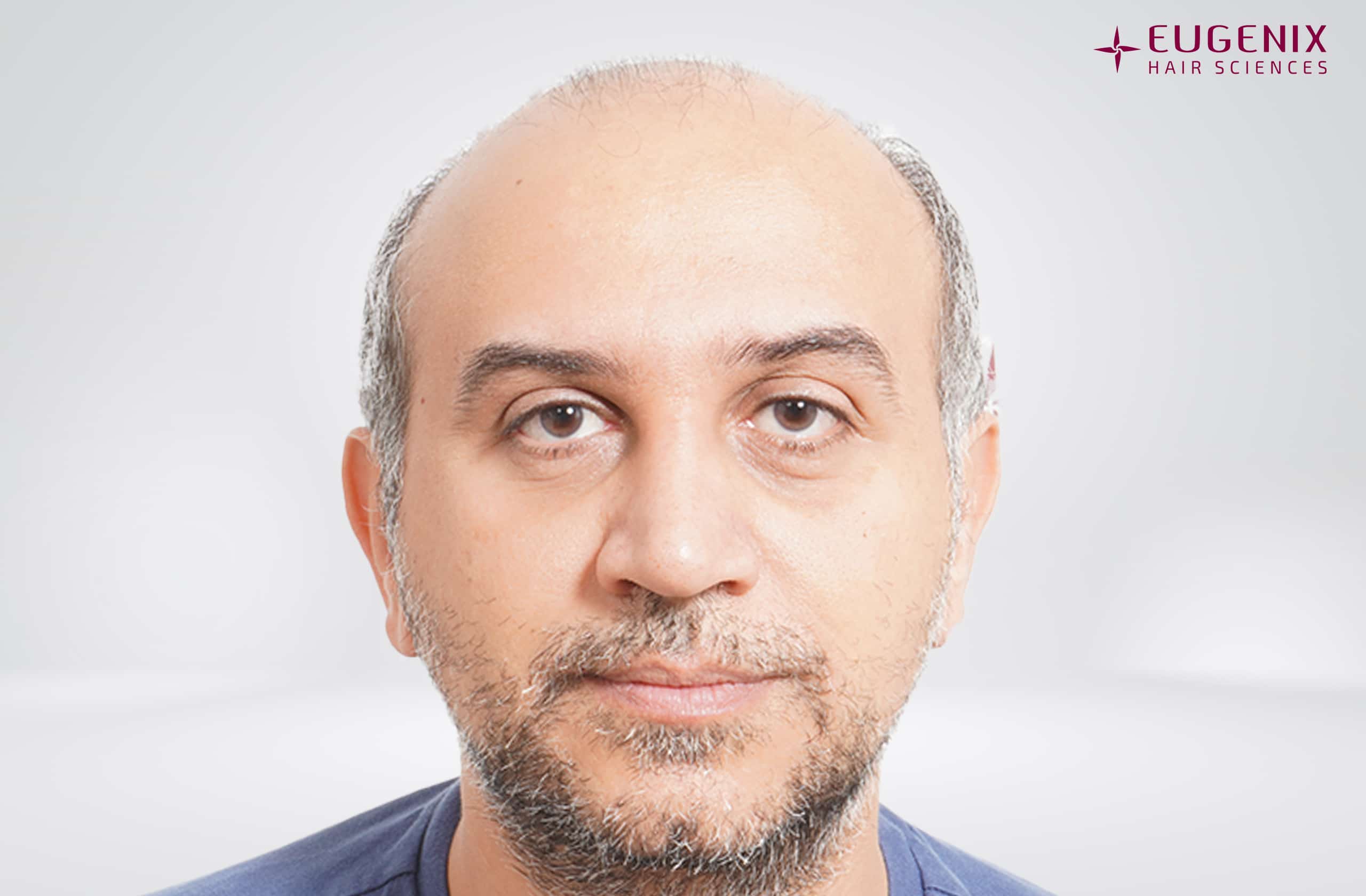 Mr-AS-Front-Pre-op