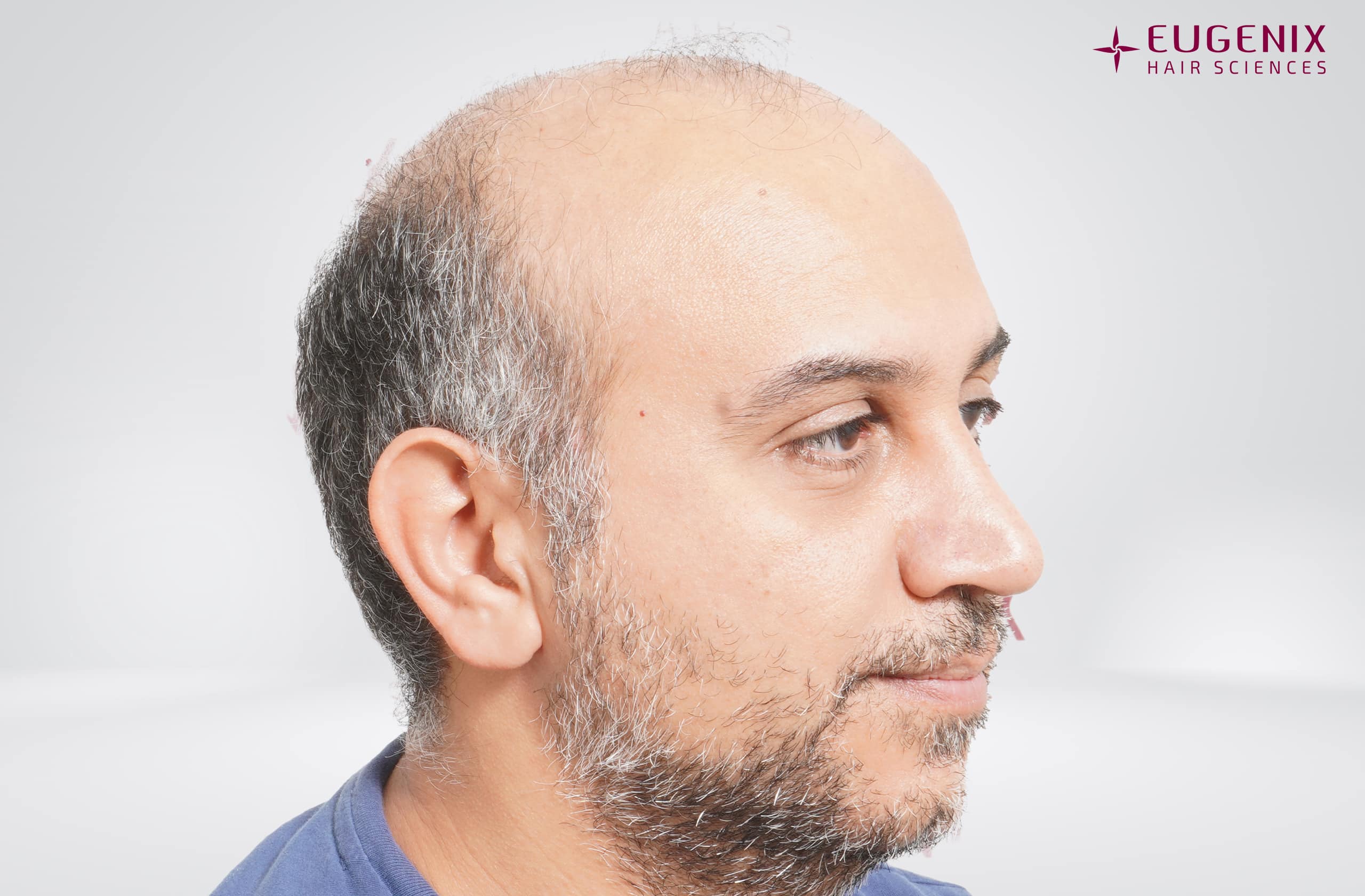 Mr-AS-Left-Pre-op