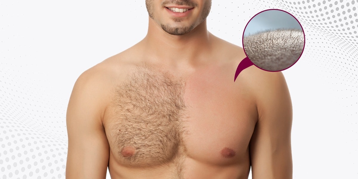 body-hair-transplant-hyderabad