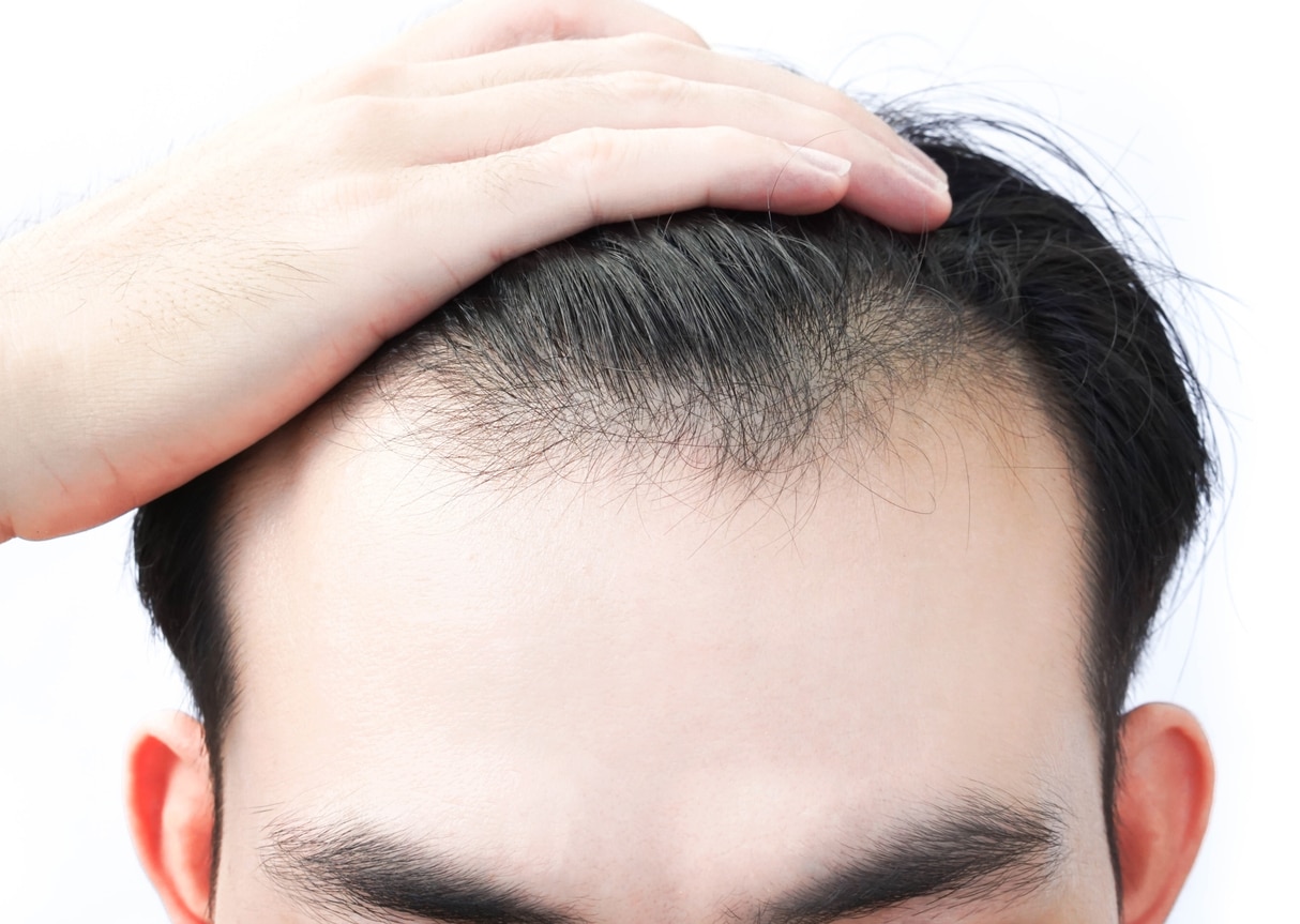Young man serious hair loss problem for health care medical and shampoo product concept