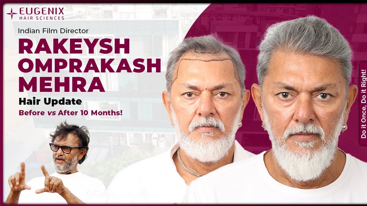 rakesh-omprakash-hair-transplant