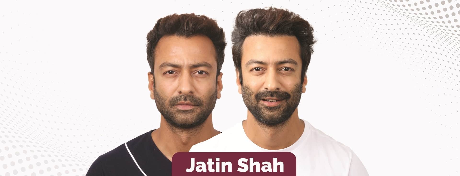 From Screen to Confidence: Indian Actor Jatin Shah’s Hair Transplant Journey with Eugenix
