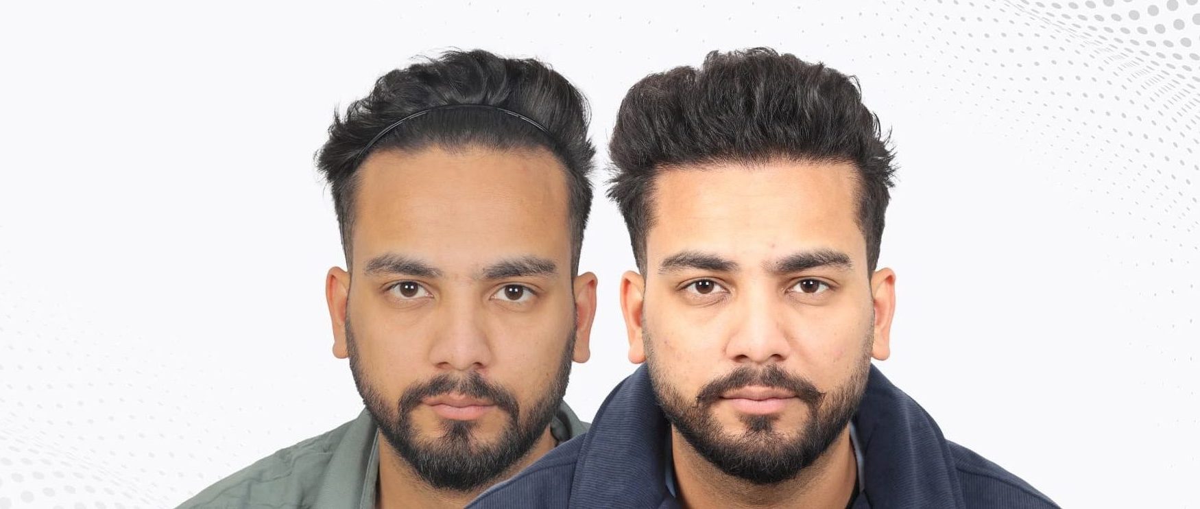 A Complete Guide to 2,000 Grafts Hair Transplant: Coverage, Donor Capacity & Results Expectations